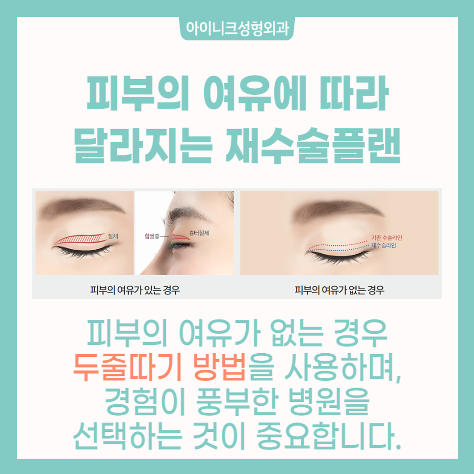 눈재수술성형외과에서 소시지 눈 고민 해결! 관련 이미지 3