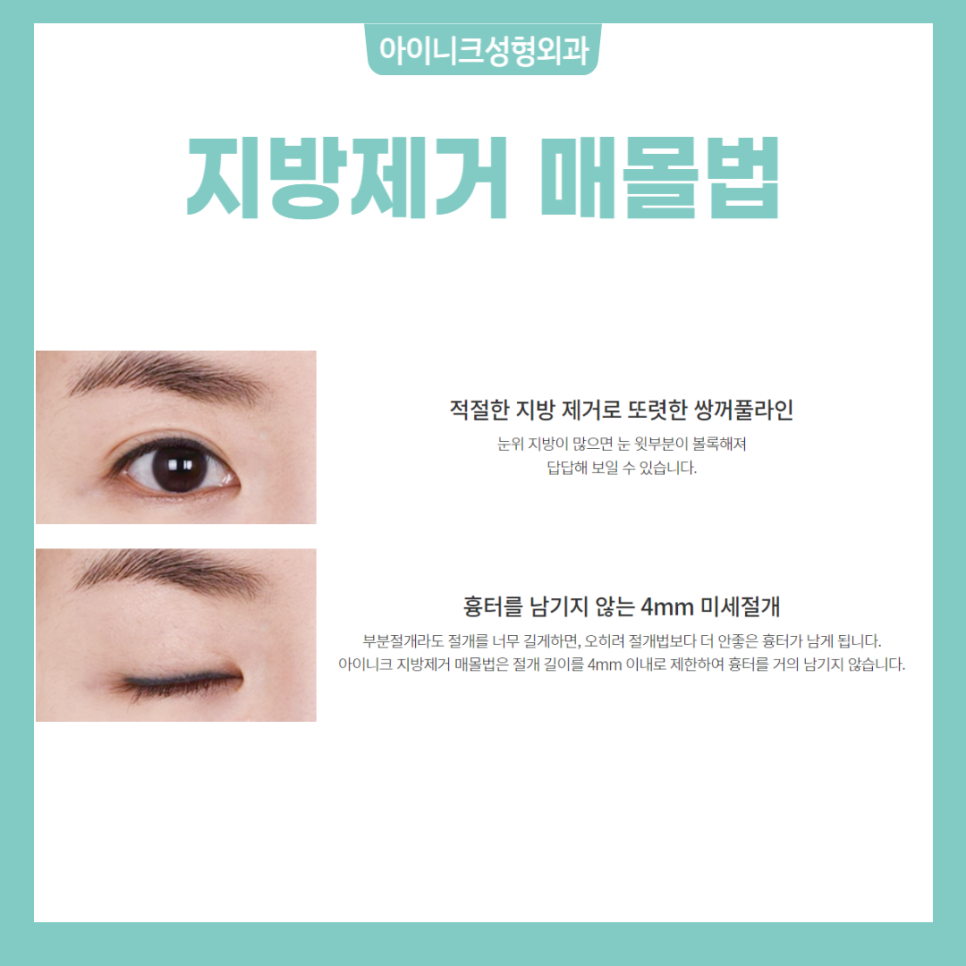 쌍꺼풀만들기 아이니크에서 알아보세요! 관련 이미지 5