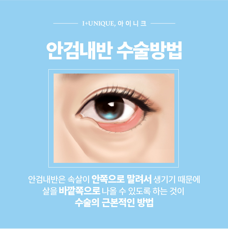 안검내반 성형외과 찾는다면? ㅇㅇㄴㅋ 성형외과 관련 이미지 4