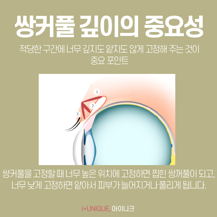 쌍커풀잘하는곳 찾고 있다면 이건 확인해 봐야죠! 관련 이미지 4