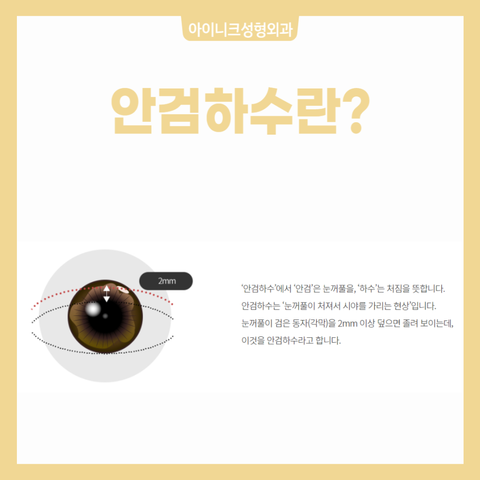 Making Sleepy-Looking Eyes Clear with Ptosis Correction image 3