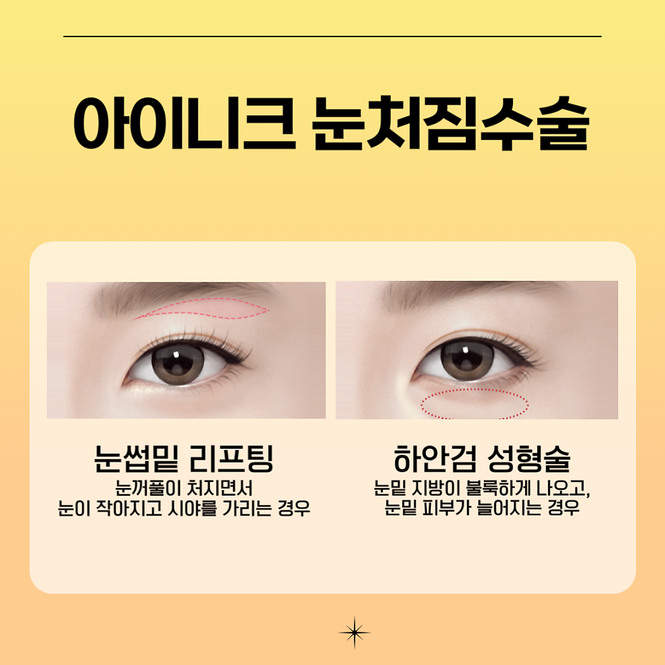 눈처짐수술 후기가 증명하는 아이니크 관련 이미지 2