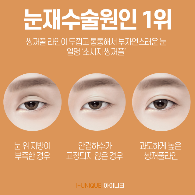 쌍꺼풀재수술병원 알아보고 있다면 경험많은 곳을 선택해야죠 관련 이미지 2