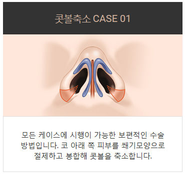콧구멍축소수술가격 작지만 큰 효과 관련 이미지 3