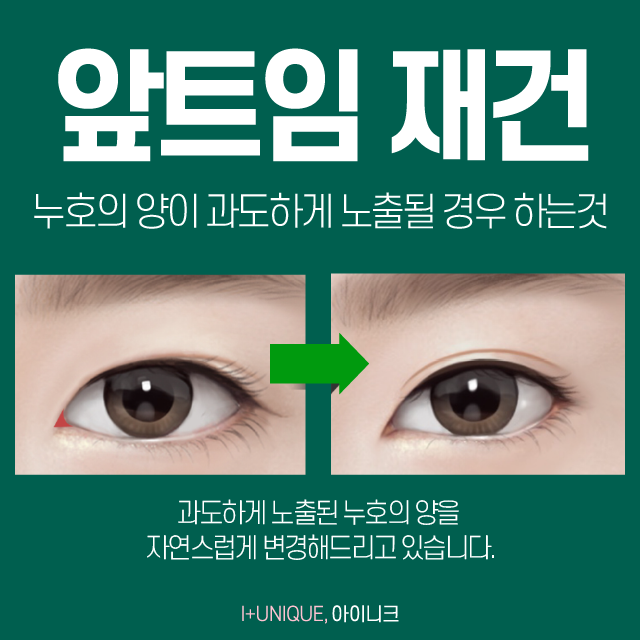 답답해 보이는 눈, 앞트임복원술이 답! 관련 이미지 3
