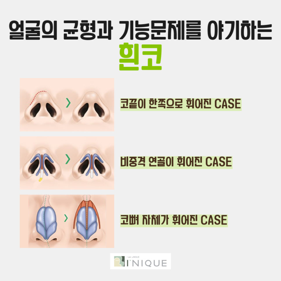 흰코성형이 고민이라면 주목! 관련 이미지 2