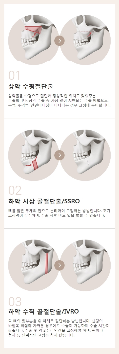 긴얼굴양악 최소 선교정으로 안전하고 확실하게! 관련 이미지 2