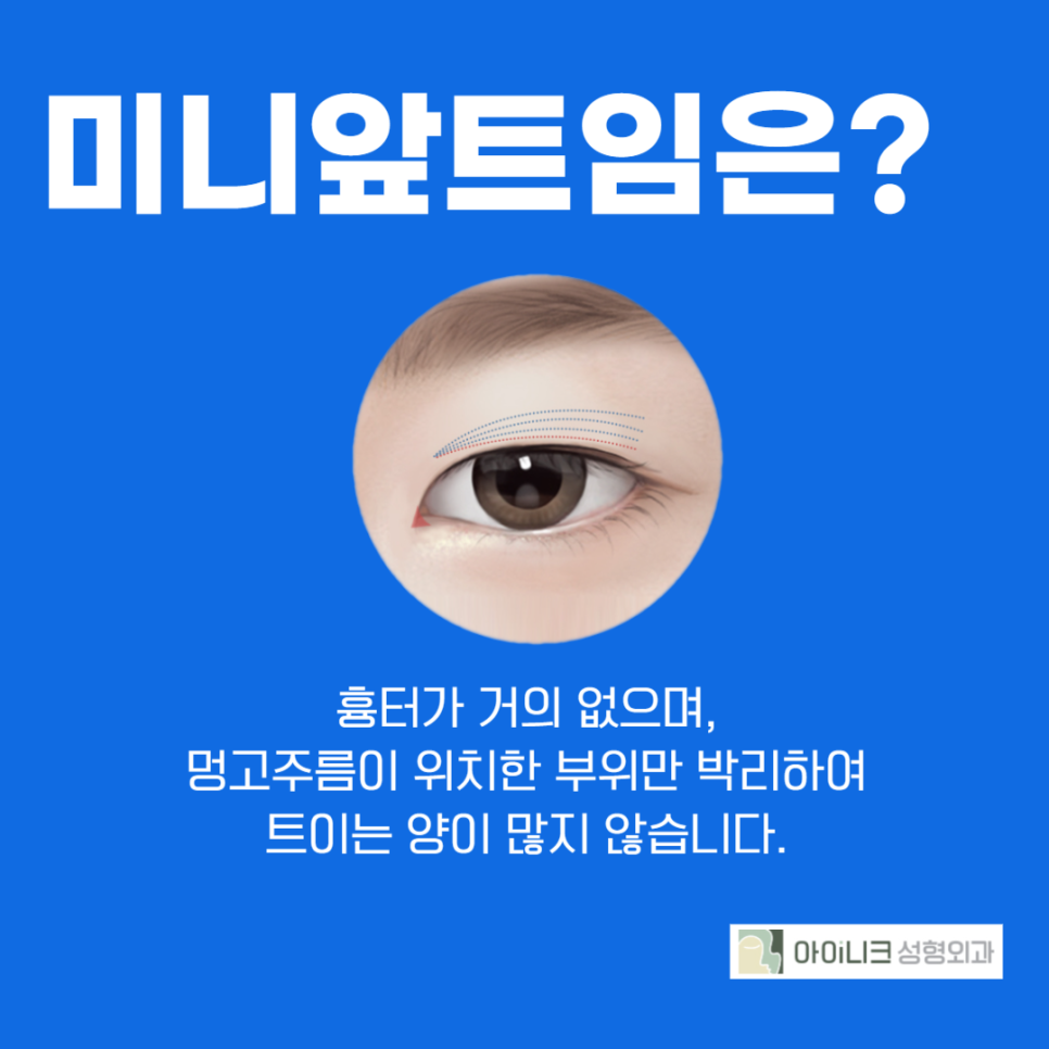 압구정앞트임 실력있는 곳을 원한다면 관련 이미지 5