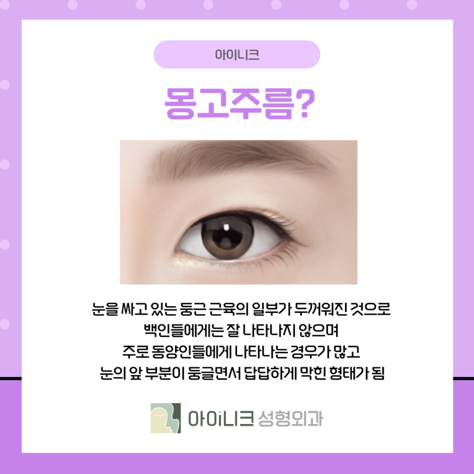 앞트임눈매교정 과하지 않고 자연스럽게 관련 이미지 7