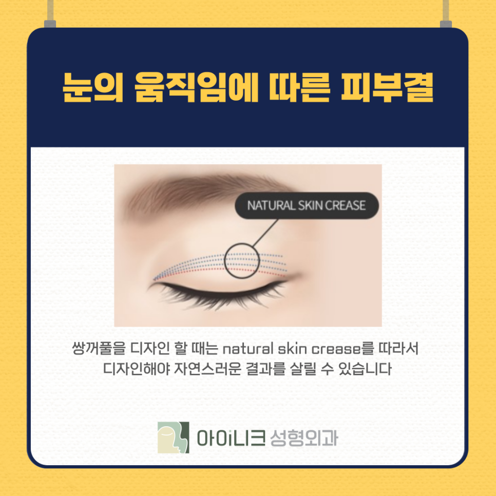 쌍수잘하는병원 실패없이 잘 선택하려면 관련 이미지 11