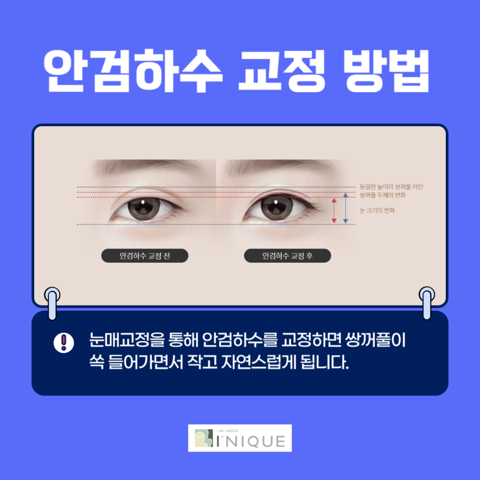 Be More Careful Than Simply Looking for the Best Place for Eye Revision Surgery image 5
