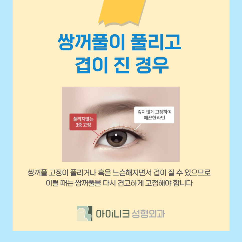 쌍꺼풀 재수술 기간 언제부터 가능한가요? 관련 이미지 10