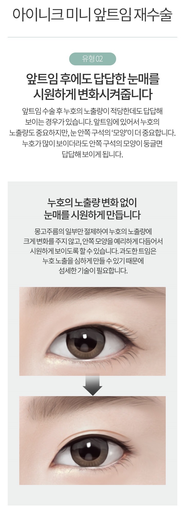 앞트임복원가격 걱정 없는 아이 니크! 관련 이미지 4