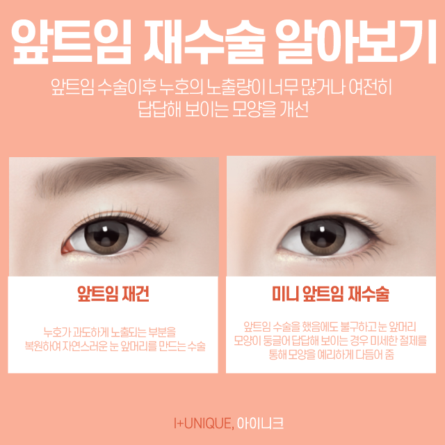 과교정이 된 눈, 수술을 해도 어딘가 답답한 눈은 앞트임복원술로 해결! 관련 이미지 2