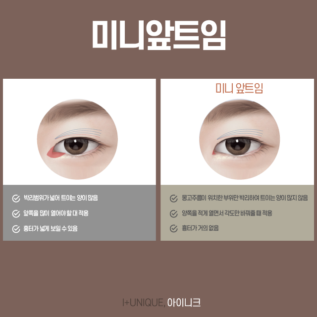 뒤트임성형 이제 더 이상 고민하지 마세요! 관련 이미지 5