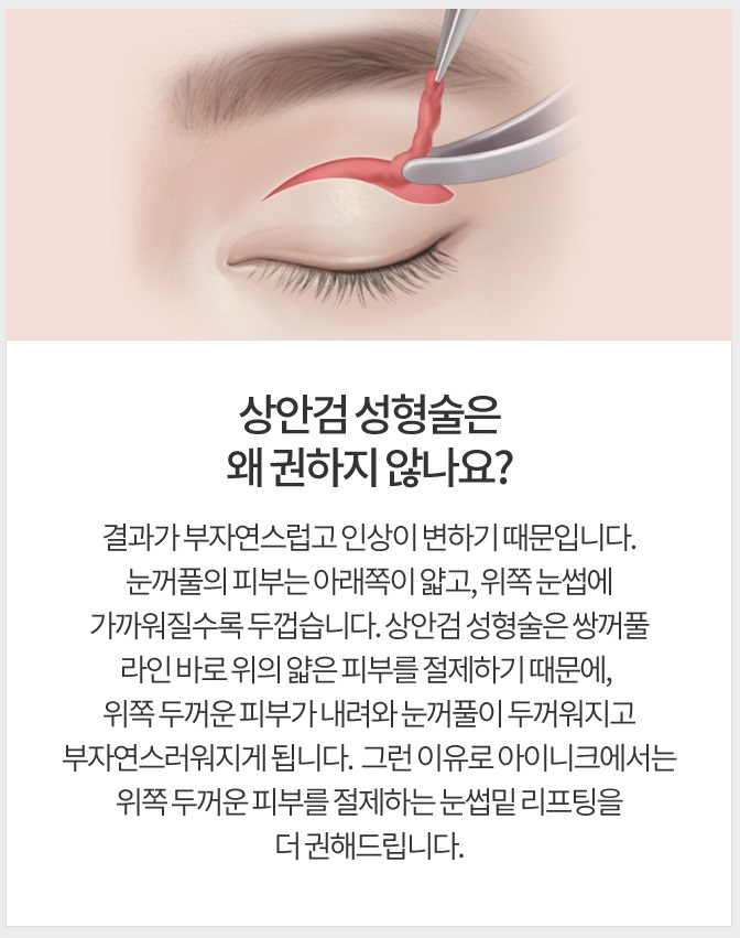 상안검성형술로 다시 20대의 눈매! 관련 이미지 5