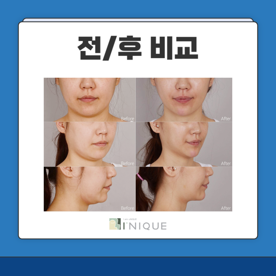 턱선시술 종류 및 효과 궁금하다면? 관련 이미지 6