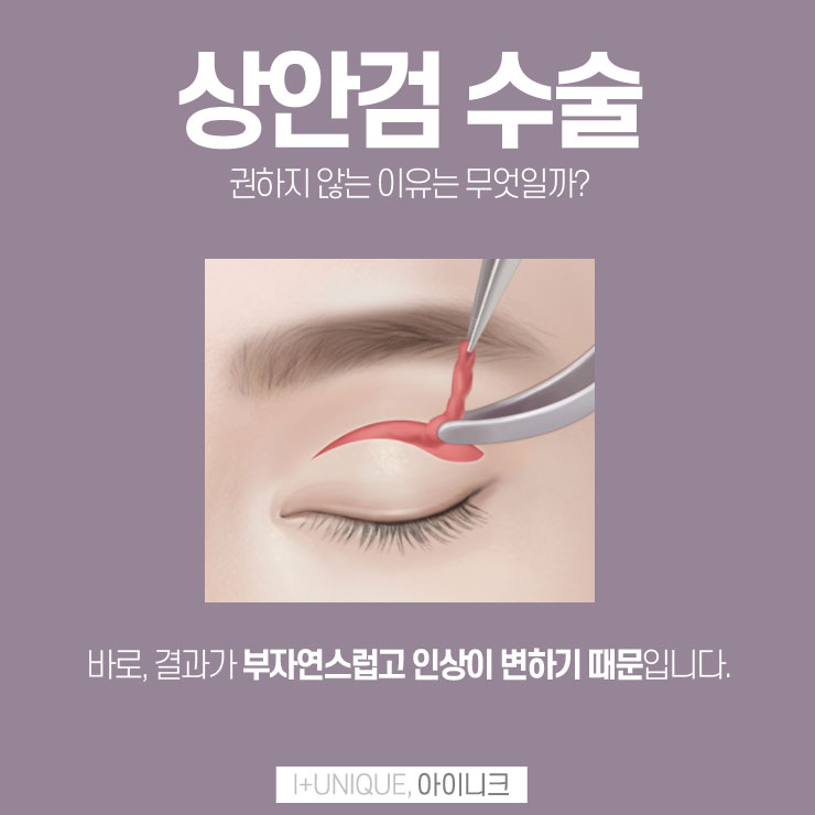 상안검수술 권하지 않는 이유 아이니크성형외과에서 알아보자 관련 이미지 2