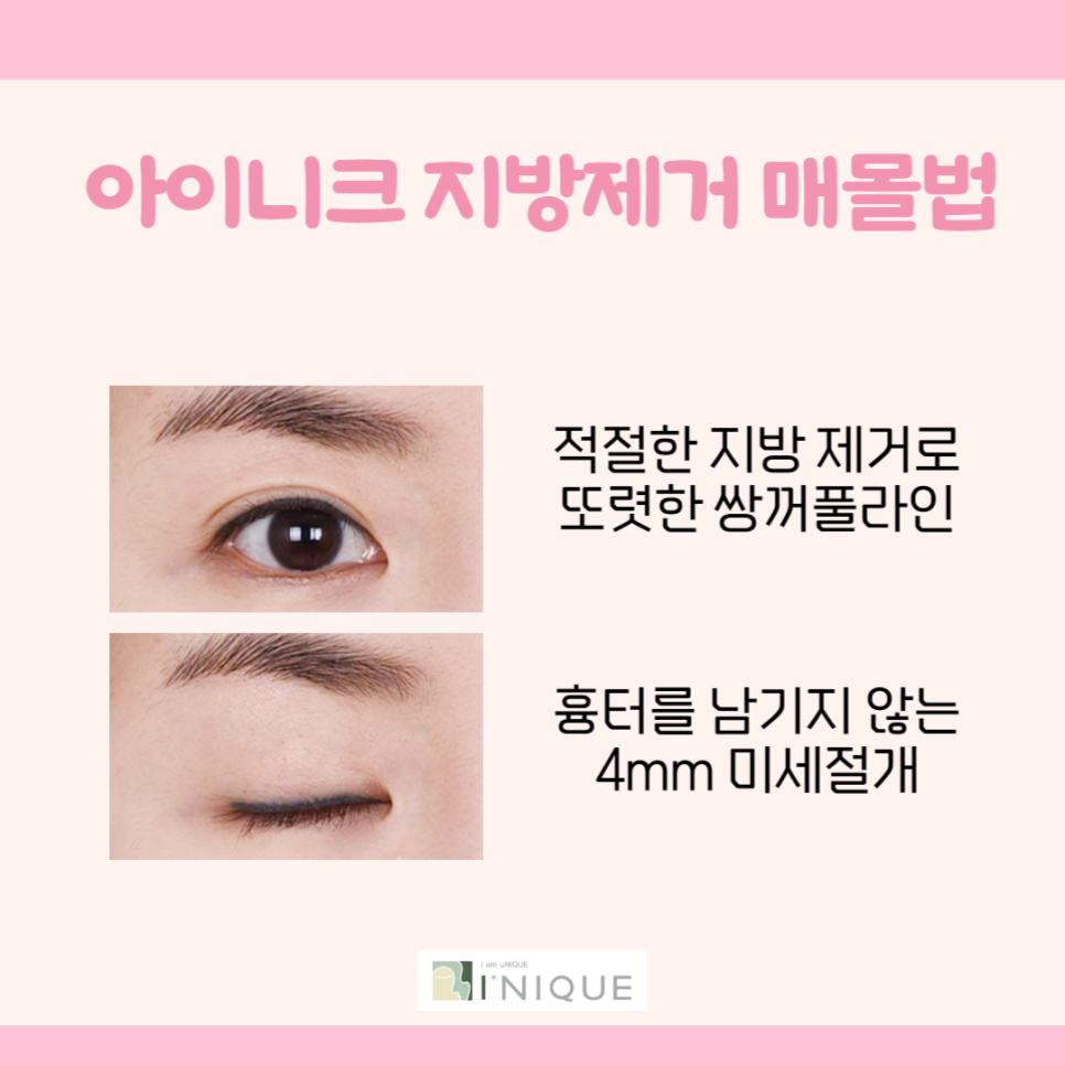 자연스러운 쌍수를 위한 중요한 점 관련 이미지 4
