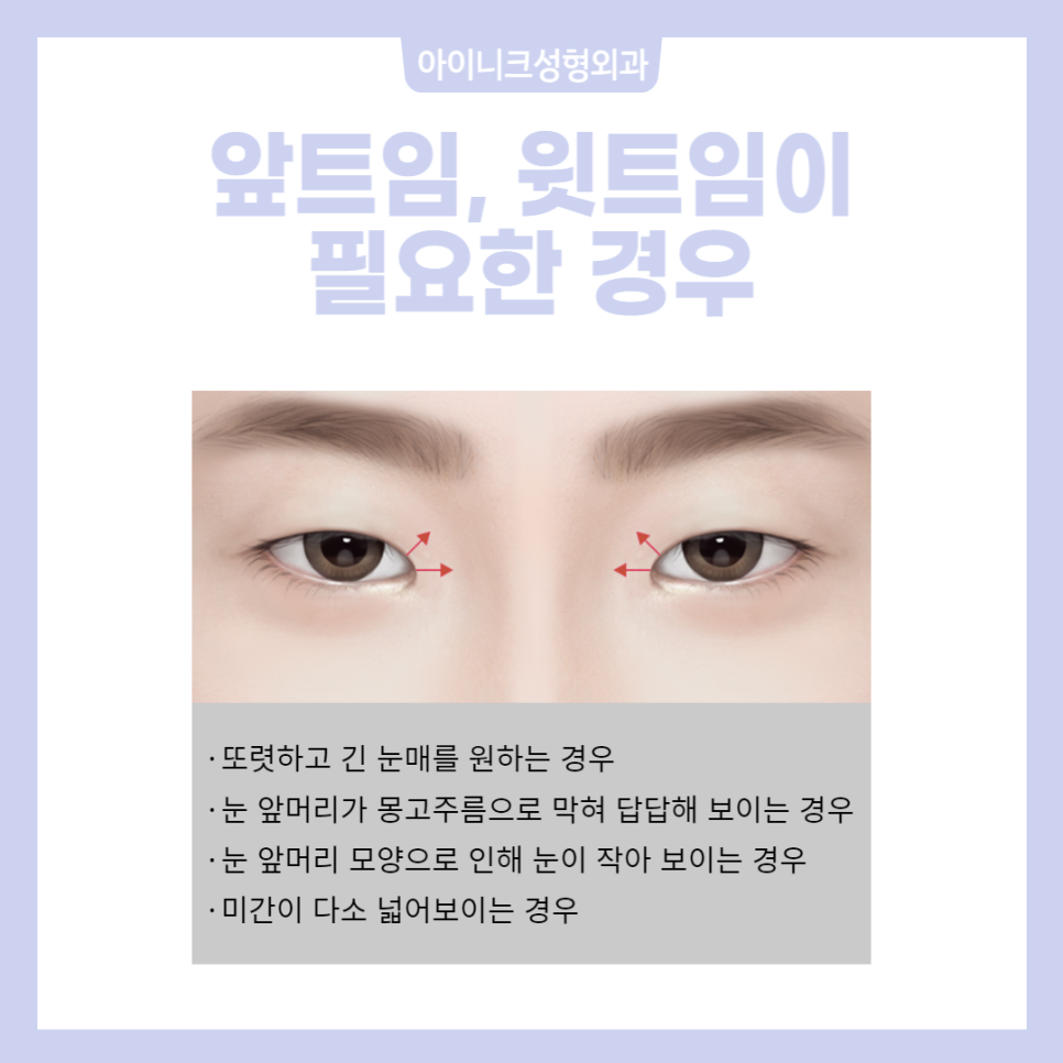 눈트임수술종류 다양하게 알아보고 선택하자! 관련 이미지 4