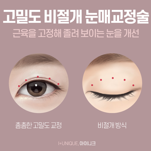 남녀노소 가능한 눈매교정술 그리고 가격까지 한 번에 알아보자! 관련 이미지 3