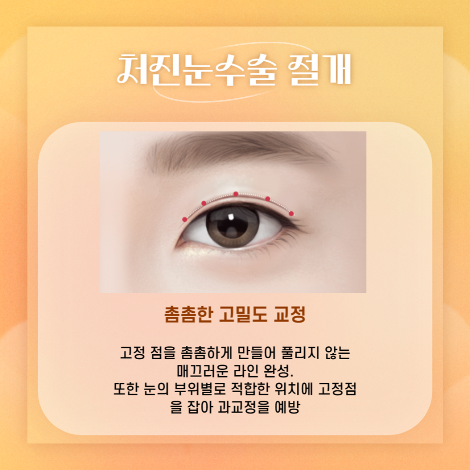 처진눈수술, 안전하고 회복이 빠른 아이니크 관련 이미지 4