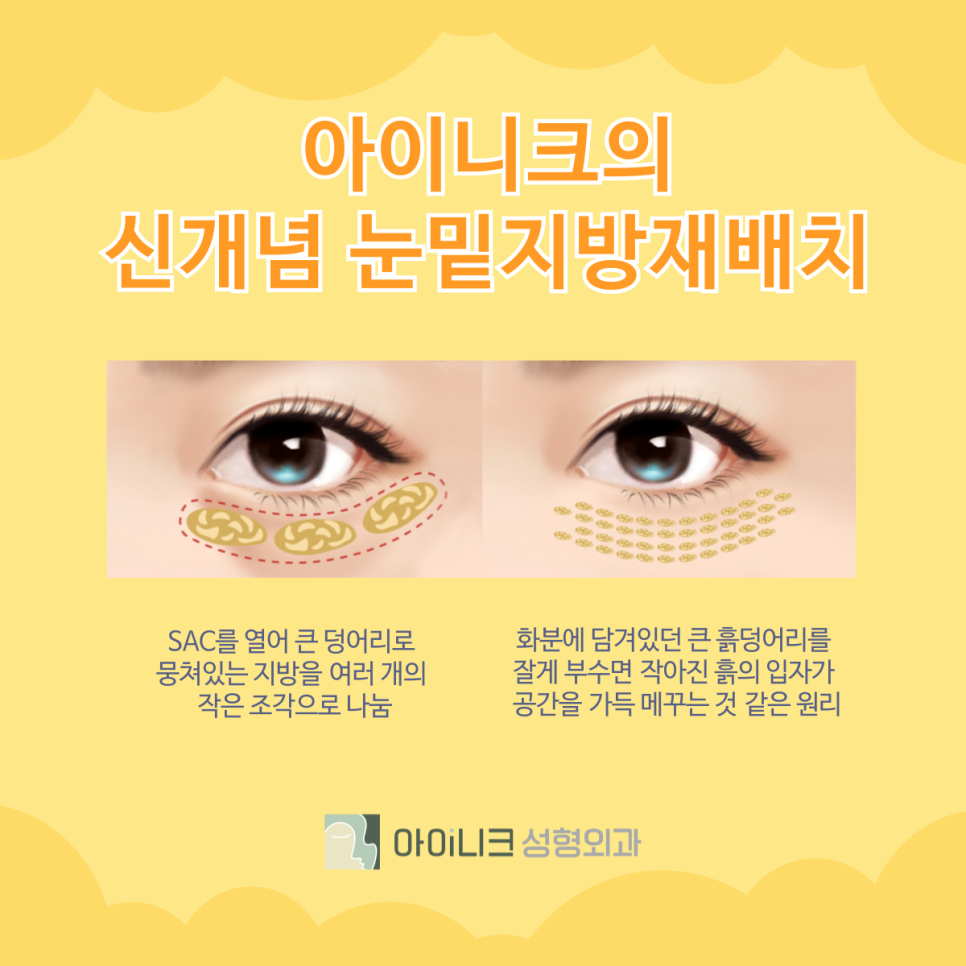 눈밑지방재배치수술병원 제대로 선택하기 관련 이미지 4