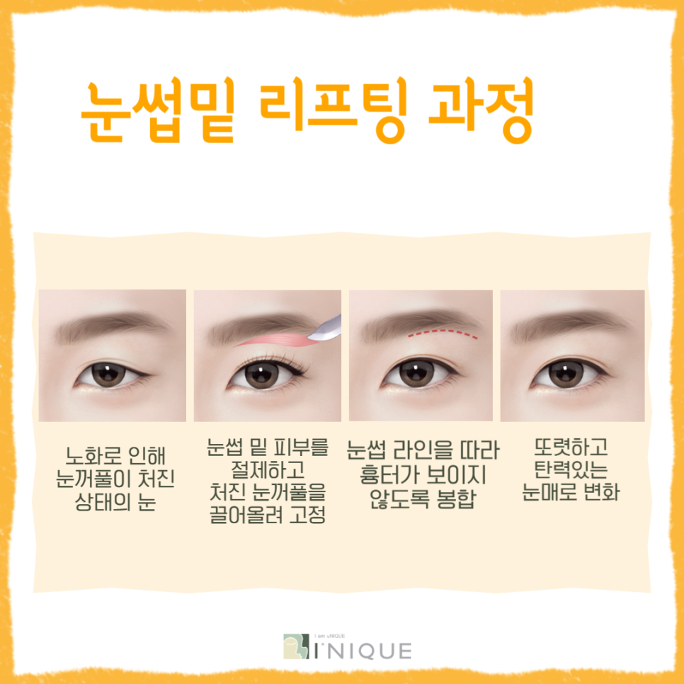 Have You Heard About Middle-Age Eye Rejuvenation Surgery? image 4