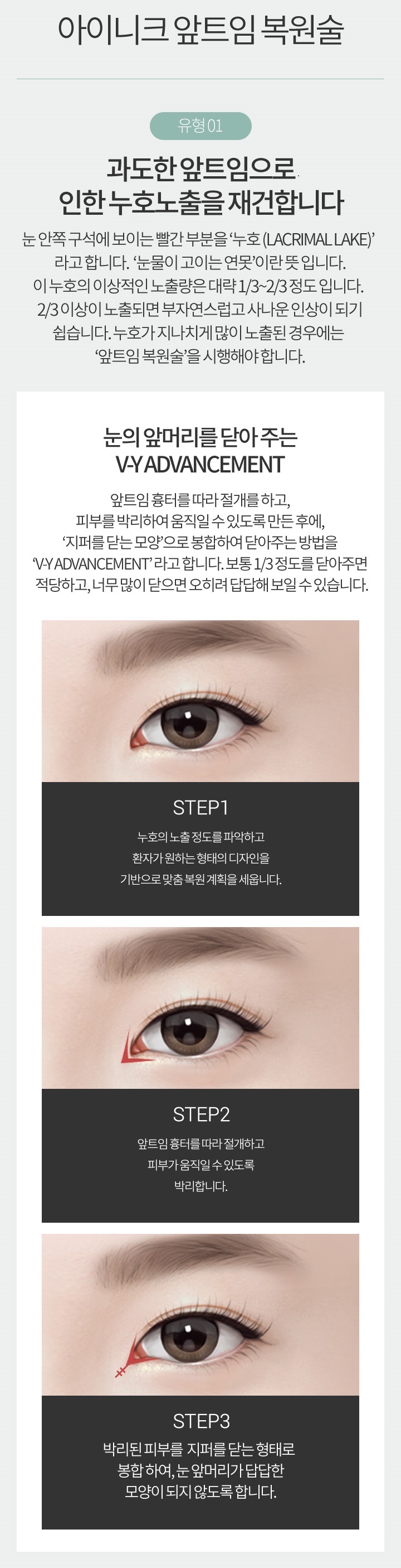 앞트임복원가격 걱정 없는 아이 니크! 관련 이미지 3