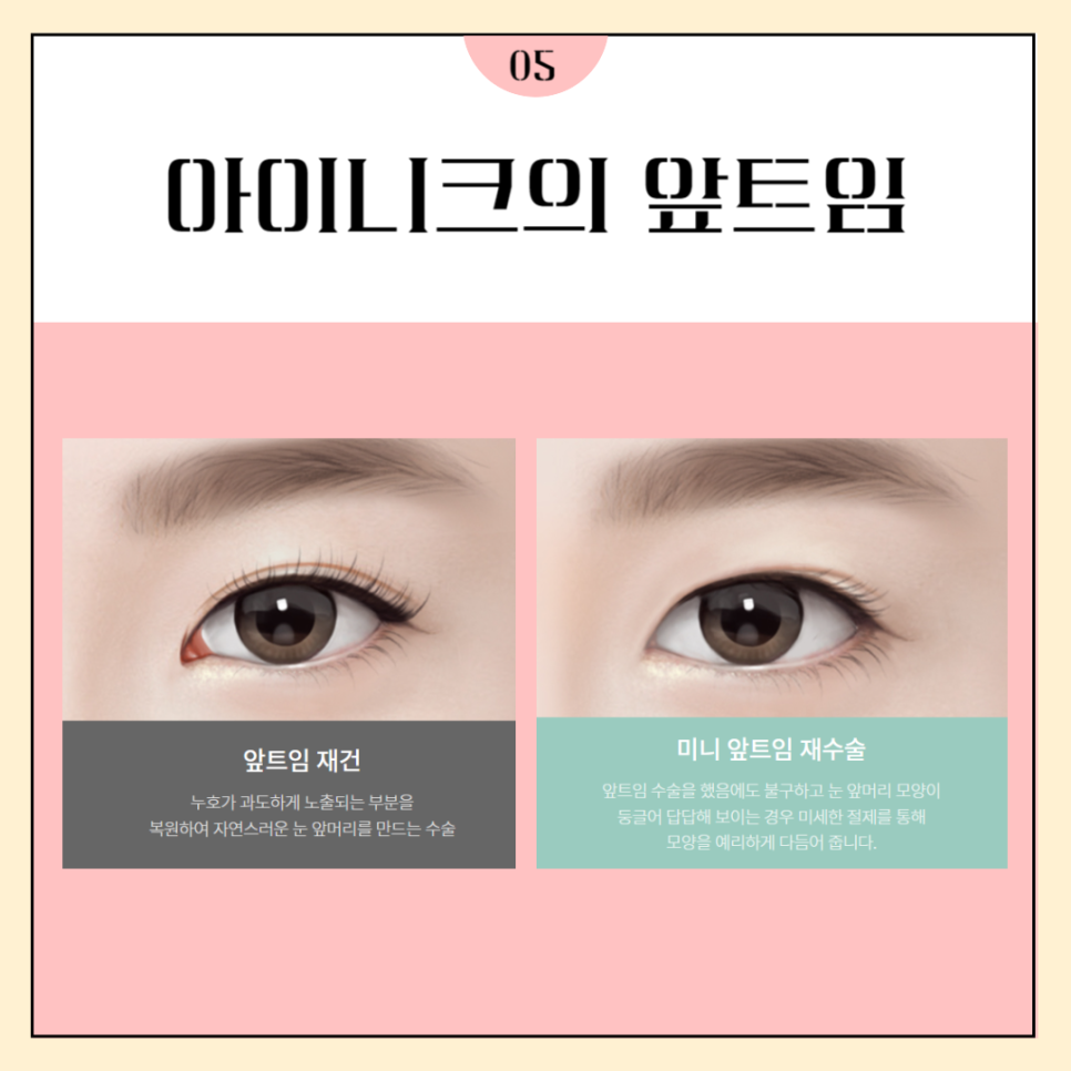 눈재수술병원 마지막이 되도록 관련 이미지 5
