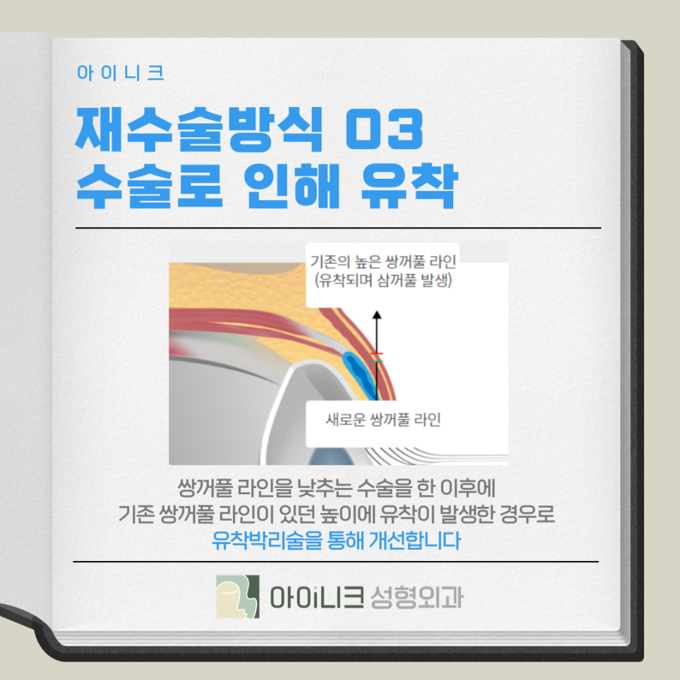 겹쌍꺼풀 여러 개의 주름이 생기는 증상일까요? 관련 이미지 10