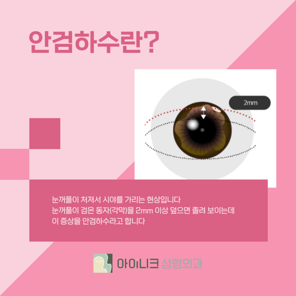 압구정눈성형외과 눈매교정으로 안검하수 개선하기 관련 이미지 4