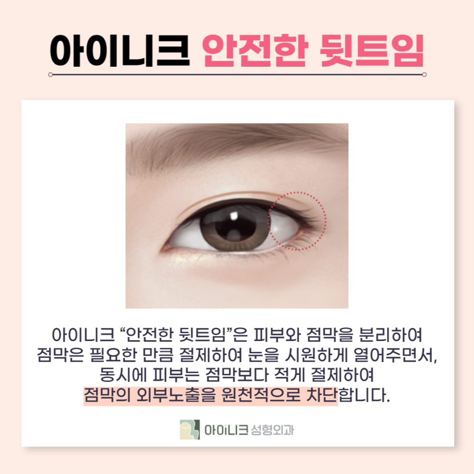 눈꼬리수술로 강아지상 만든 후기 관련 이미지 6