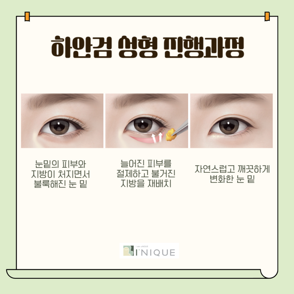 하안검잘하는병원 효도선물로 찰떡 관련 이미지 2