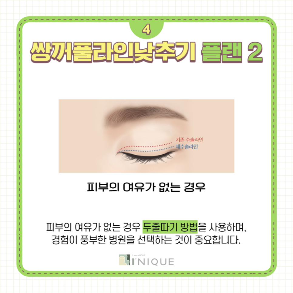 쌍꺼풀라인낮추기 가장 중요한 것은 병원선택! 관련 이미지 5