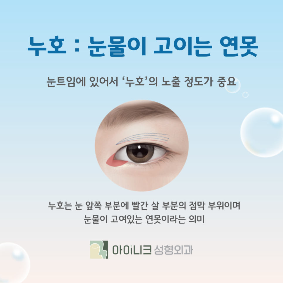 눈 트임 성형 꽉 막힌 몽고주름 개선하는 방법 관련 이미지 8