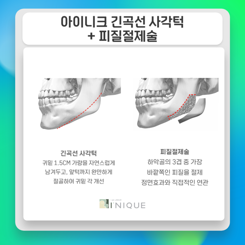Key Points of Facial Contouring Surgery image 2