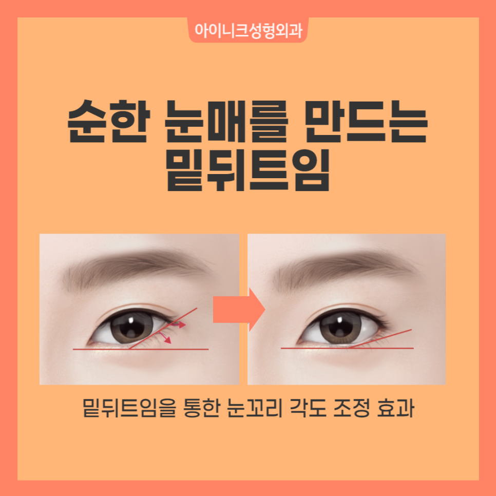뒤트임성형 자연스러운 아름다움을 위해 관련 이미지 5