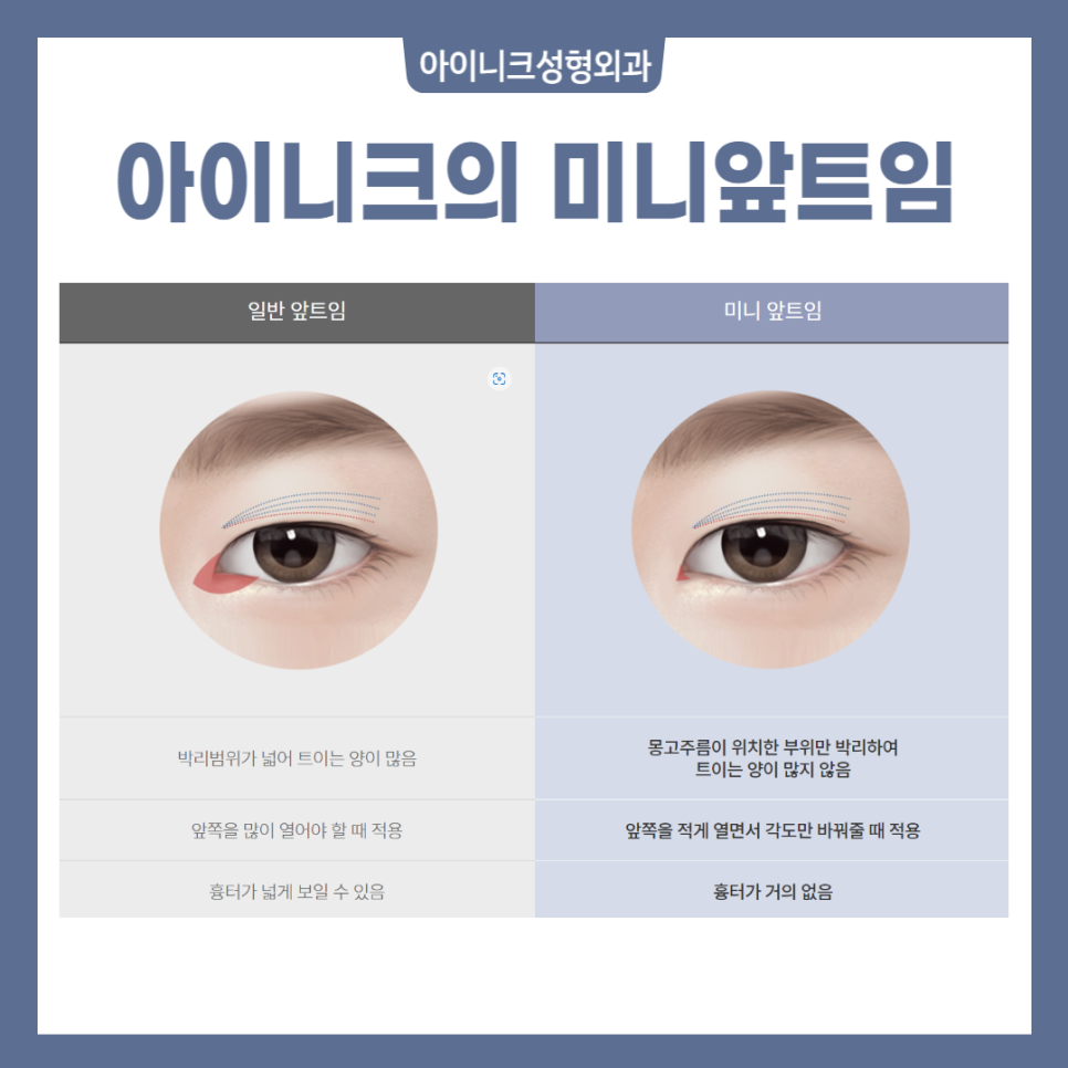 The Secret to a Natural, Clear Eye Shape with Outer Corner Surgery image 3