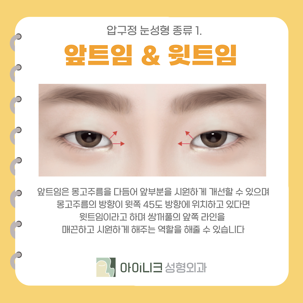 Types of Eye Surgery in Apgujeong: Making the Eye Shape Clearer and Brighter with Canthoplasty image 4