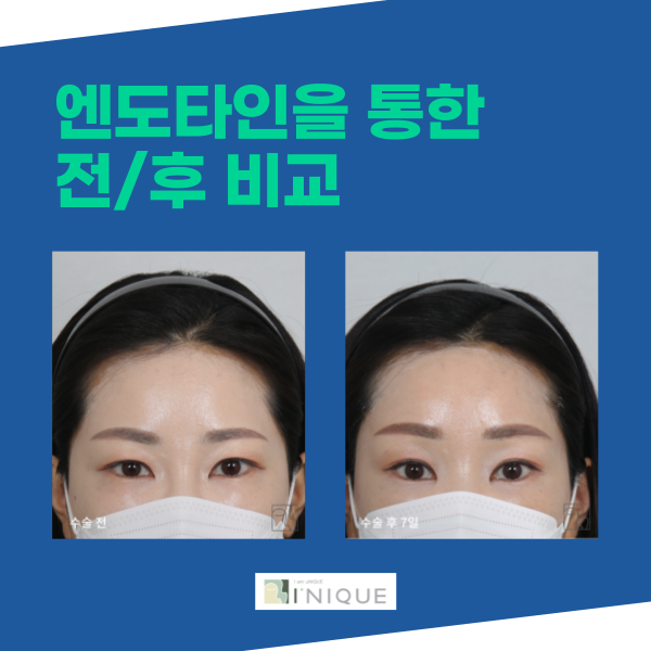 If You’re Considering a Good Place for Eyebrow Lift Surgery image 5