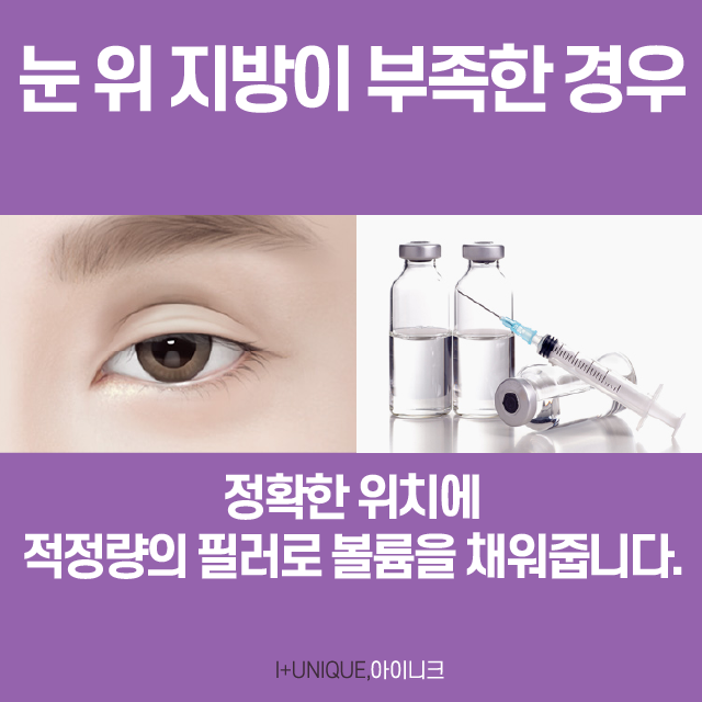 눈재수술유명한곳 제대로 찾는다면? 관련 이미지 5
