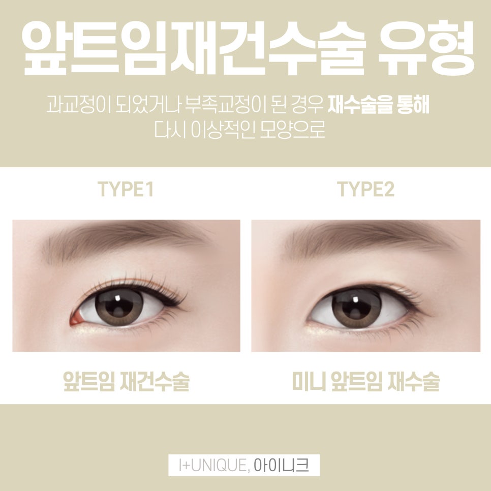 자연스러운 앞트임성형 아이니크성형외과에서 관련 이미지 2