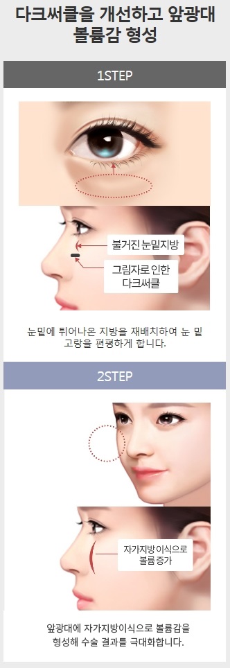 다크서클수술비용 걱정 없이 환한 얼굴로 변신! 관련 이미지 3