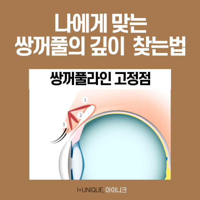 쌍꺼풀 재수술 방법 바로 알고 선택하자! 관련 이미지 4