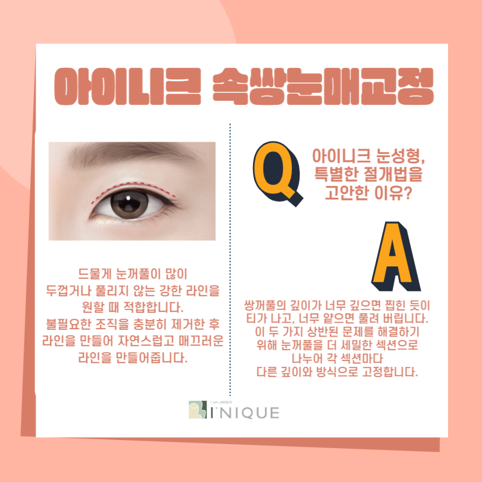 남자짝눈교정, 더 자연스럽고 또렷하게! 관련 이미지 3