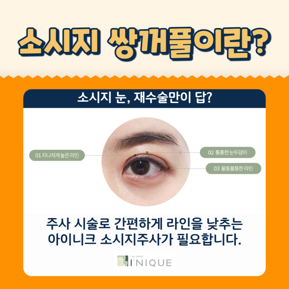눈붓기주사로 쌍수 후 소시지 고민 해결하기 관련 이미지 2