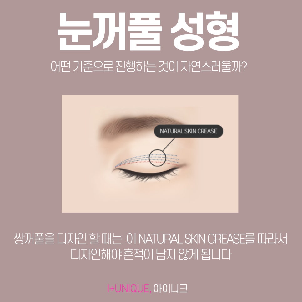 자연스러운 눈꺼풀성형 찾고 있다면 아이니크성형외과로 관련 이미지 2