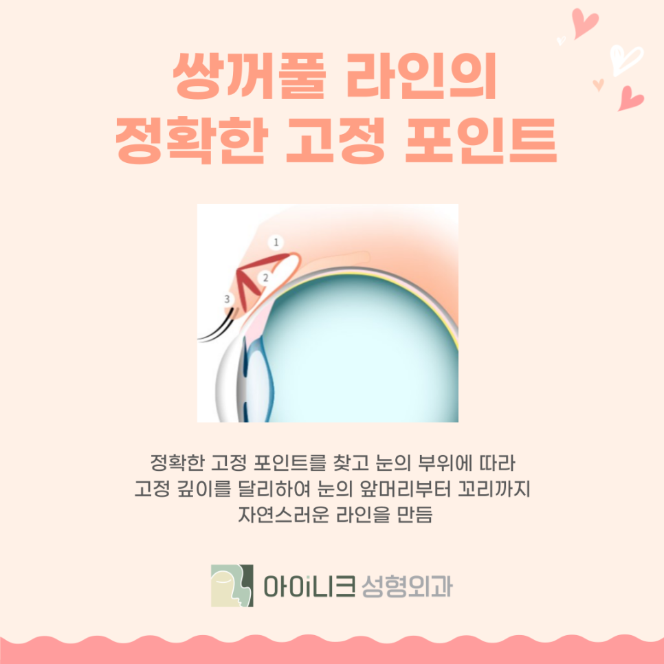 쌍꺼풀잘하는곳 어디로 가야할까? 관련 이미지 6