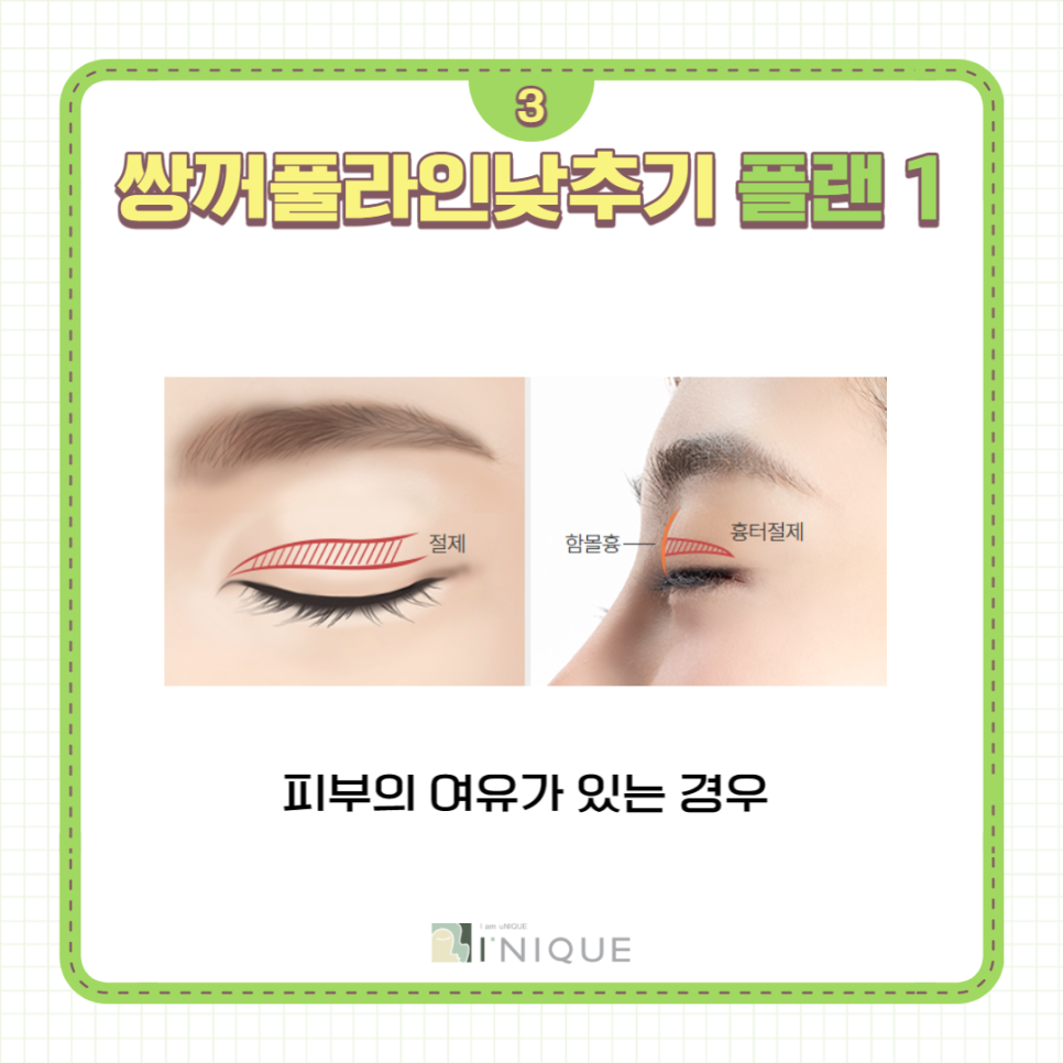 쌍꺼풀라인낮추기 가장 중요한 것은 병원선택! 관련 이미지 4